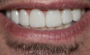 After Image: Veneers