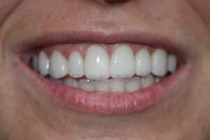 After Image: Veneers