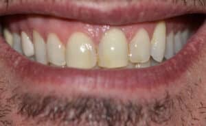 Before Image: Veneers