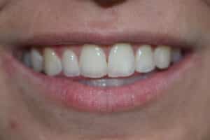 Before Image: Veneers