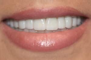 After Image: Veneers and Crowns