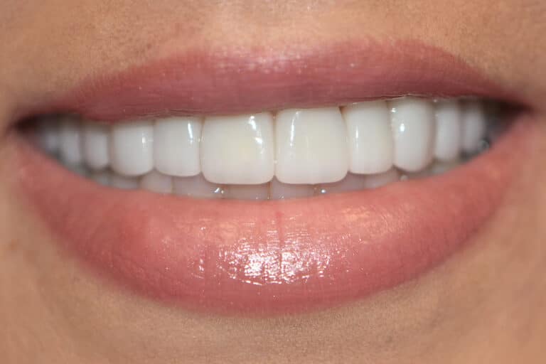 After Image: Veneers and Crowns - front