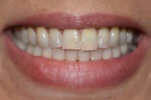 Before Image: Veneers and Crowns