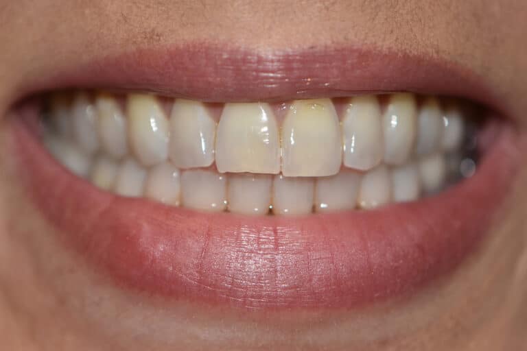 Before Image: Veneers and Crowns - front