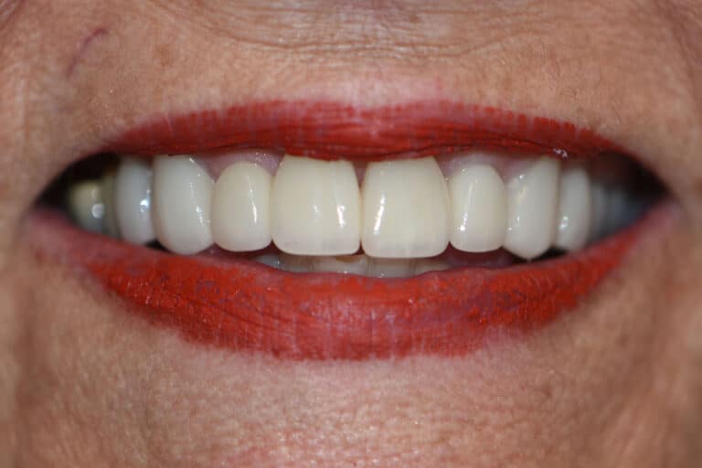 After Image: Cosmetic Crowns and Veneers - front