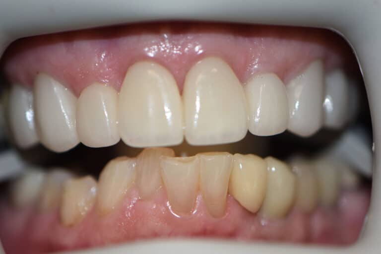 Before Image: Cosmetic Crowns and Veneers - front