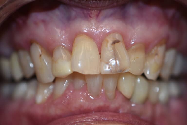 Before Image: Cosmetic Crowns and Veneers - front