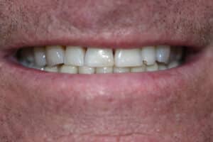 Before Image: Cosmetic Crowns